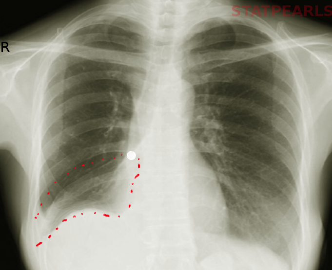 <p>Foreign Body Aspiration, Radiograph.</p>