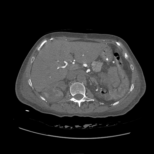 <p>Contrasted Computed Tomography of the Abdomen,&nbsp;Aortic Thrombosis.</p>