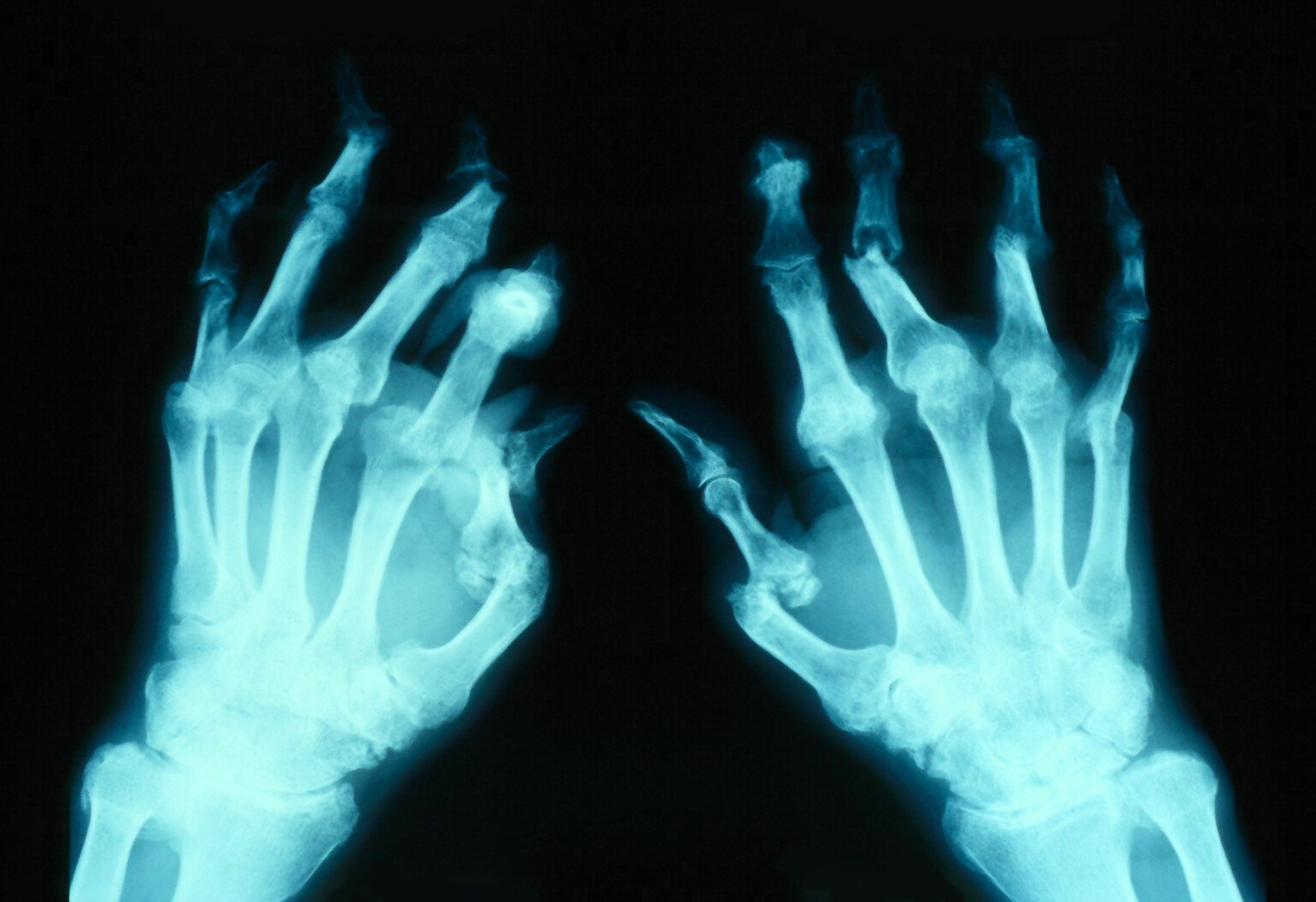<p>X-ray of Arthritis Mutilans of Hands.</p>