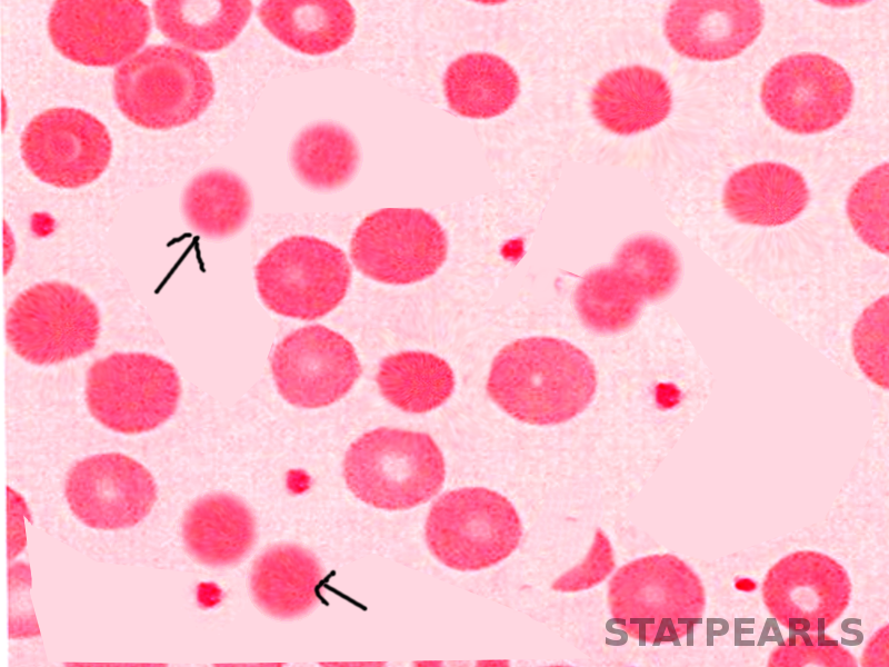 <p>Hereditary Spherocytosis