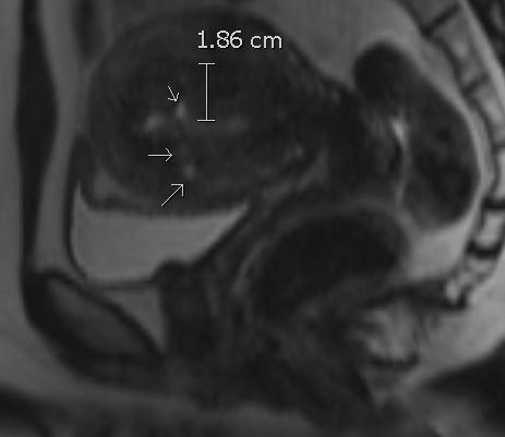 <p>Adenomyosis Imaging Findings