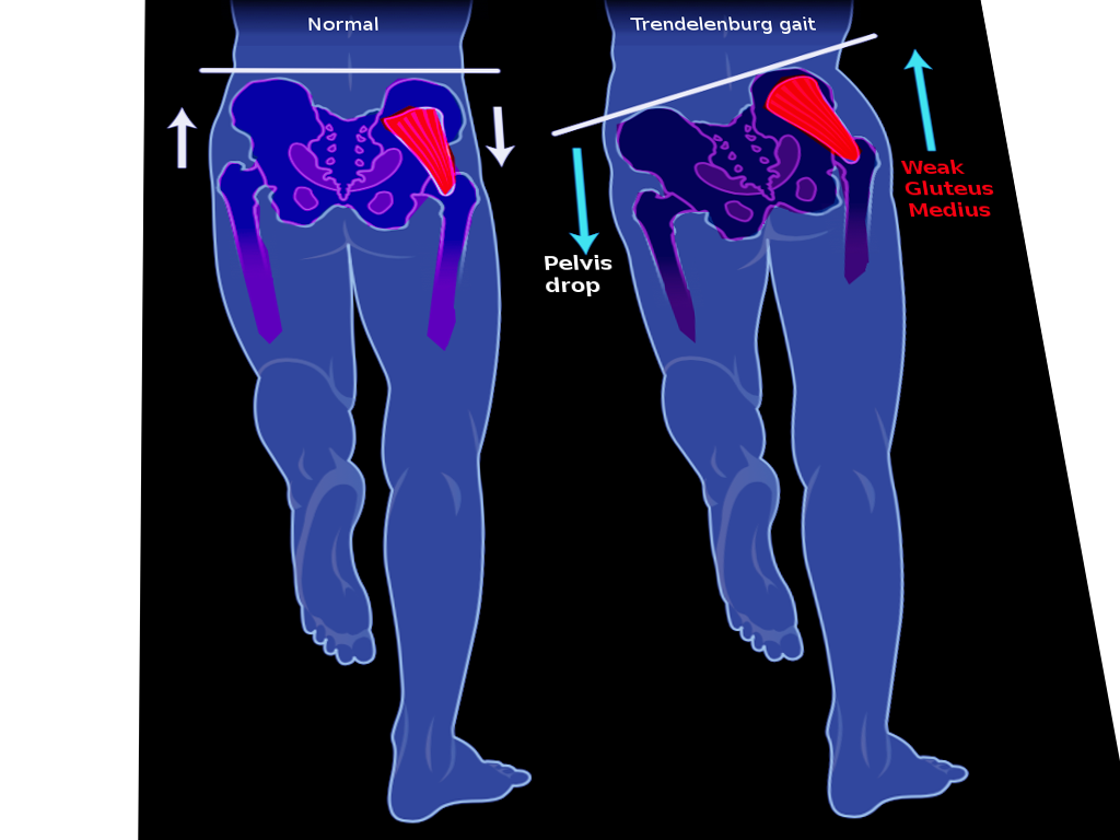<p>Trendelenburg Gait. The left image shows a normal gait, and the right image shows a Trendelenburg gait.</p>