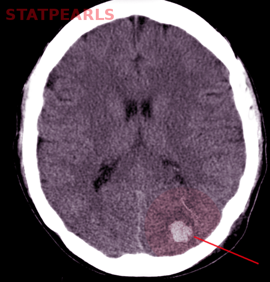 <p>Cerebellar Hemorrhage
