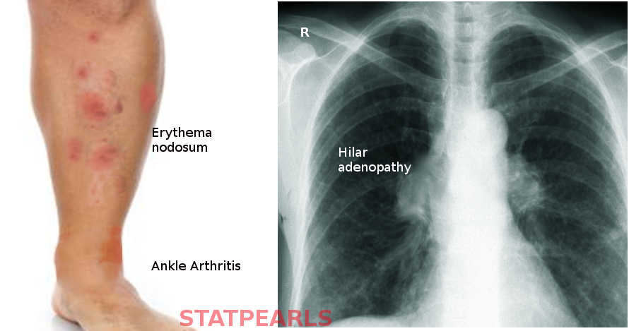 <p>Lofgren Syndrome.</p>
