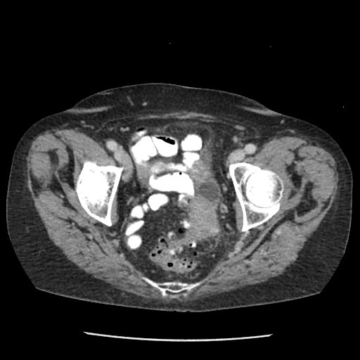 <p>Complicated Diverticulitis