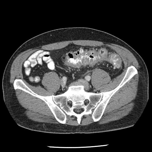 <p>Uncomplicated Diverticulitis