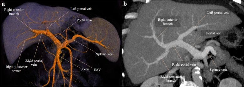 Figure 1.
Normal portal vein branching patterns as visualized by contrast-enhanced CT imaging.