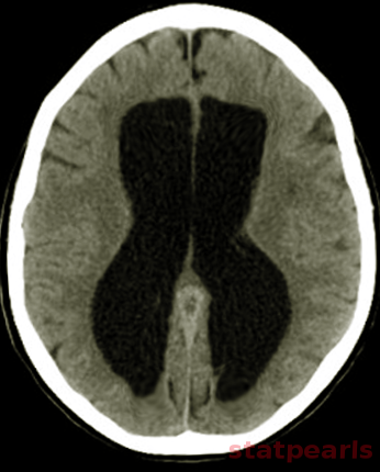 <p>Normal Pressure Hydrocephalus